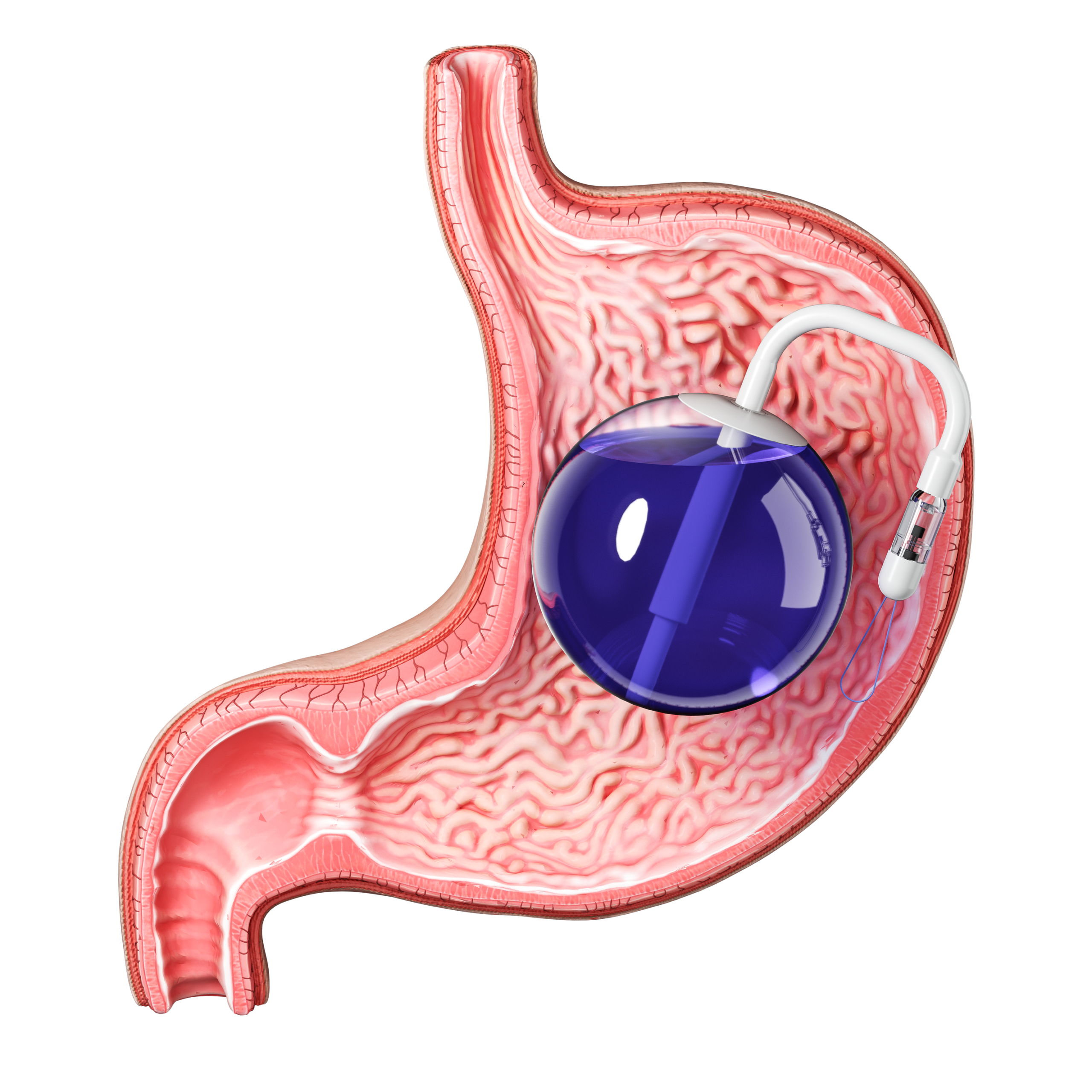 INTRAGASTRIC BALLOON - Image 2